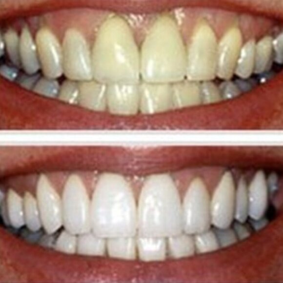 ISmile Professional Teeth Whitening Strips 28 Count Enamel Safe Zero Sensitivity - Picture 4 of 7